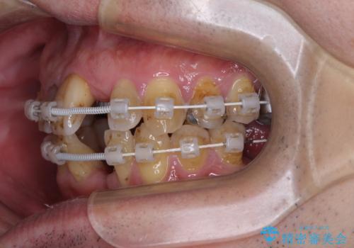 放置した歯列　矯正治療とインプラント治療で劇的に改善の治療中
