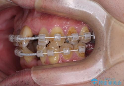 放置した歯列 矯正治療とインプラント治療で劇的に改善の治療中