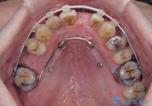 放置した歯列　矯正治療とインプラント治療で劇的に改善の治療中