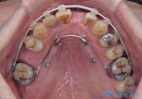 放置した歯列 矯正治療とインプラント治療で劇的に改善の治療中