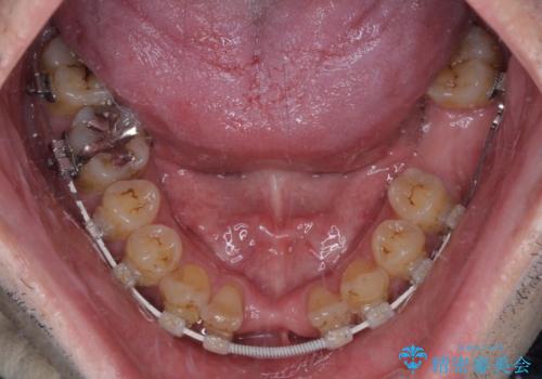 放置した歯列　矯正治療とインプラント治療で劇的に改善の治療中