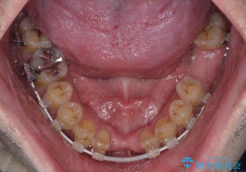 放置した歯列 矯正治療とインプラント治療で劇的に改善の治療中