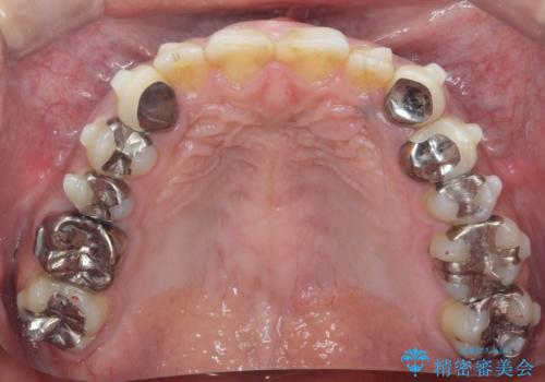 歯並びと虫歯(メタルフリー)を行った全顎治療の治療中