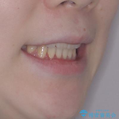 飛び出した上顎前歯 抜歯矯正で横顔の印象を改善の治療後(顔貌)