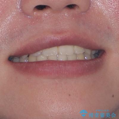 突出した口元 ワイヤー装置で横顔の印象を改善の治療後(顔貌)