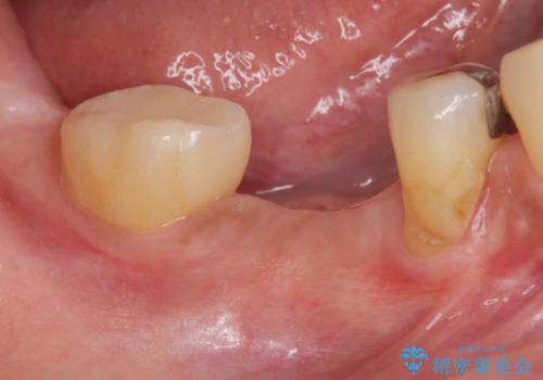 歯槽堤保存術 → インプラント治療の治療後