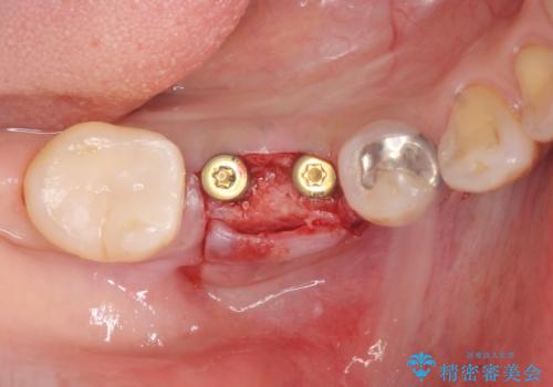 歯槽堤保存術 → インプラント治療の治療中