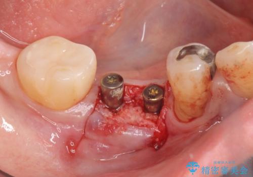歯槽堤保存術 → インプラント治療の治療中