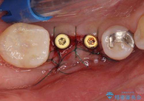 歯槽堤保存術 → インプラント治療の治療後