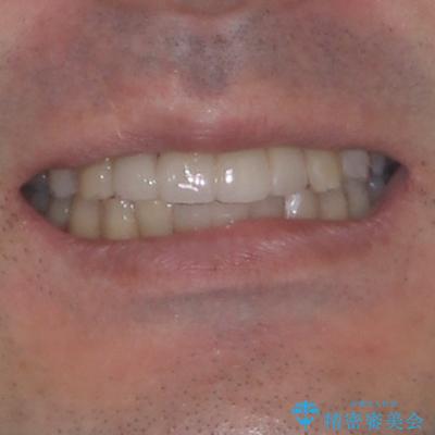 放置した歯列 矯正治療とインプラント治療で劇的に改善の治療後(顔貌)