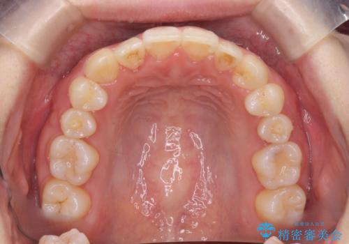八重歯　歯を抜かずにマウスピース矯正で　インプラント矯正で上の奥歯を後ろに移動の治療後