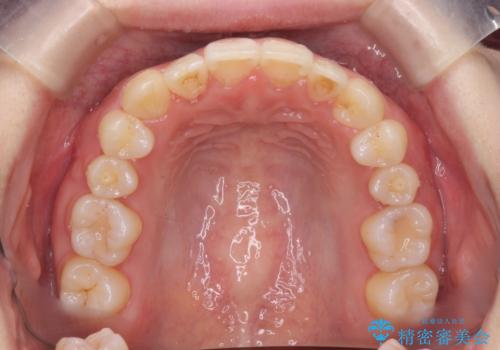 八重歯 歯を抜かずにマウスピース矯正で インプラント矯正で上の奥歯を後ろに移動の治療後