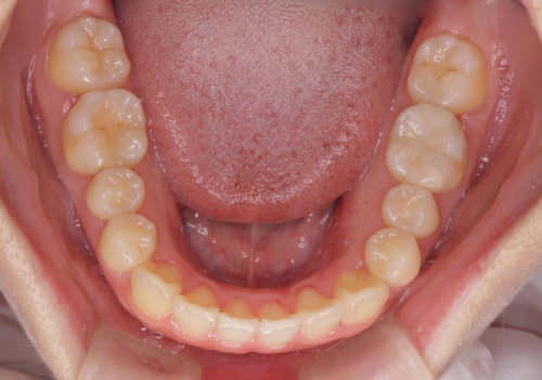 八重歯 歯を抜かずにマウスピース矯正で インプラント矯正で上の奥歯を後ろに移動の治療後