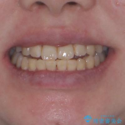 インビザラインが続けられない ワイヤー矯正に切り替えてデコボコを改善の治療後(顔貌)