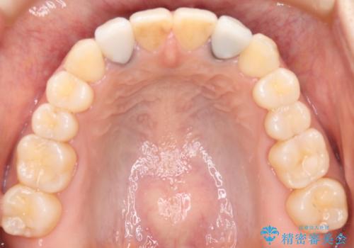 仮歯からセラミックへ　色合わせで自然な色調の再現の治療前