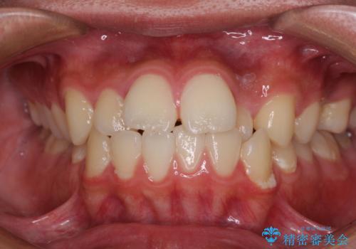 突出した口元 ワイヤー装置で横顔の印象を改善の症例 治療前