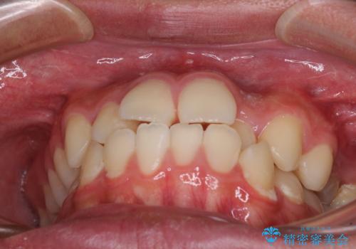 突出した口元 ワイヤー装置で横顔の印象を改善の治療前