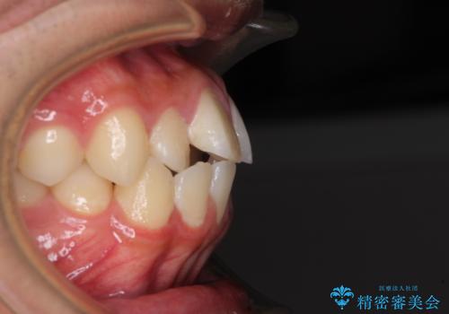 突出した口元 ワイヤー装置で横顔の印象を改善の治療前