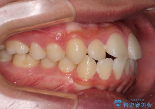 突出した口元 ワイヤー装置で横顔の印象を改善の治療前