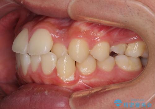 突出した口元 ワイヤー装置で横顔の印象を改善の治療前