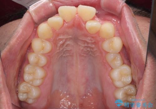 突出した口元 ワイヤー装置で横顔の印象を改善の治療前