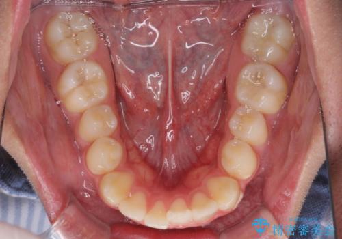 突出した口元 ワイヤー装置で横顔の印象を改善の治療前