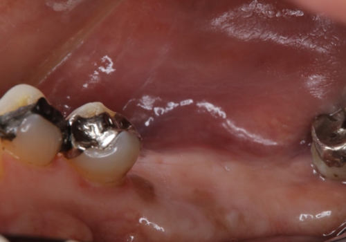 大臼歯 2本インプラントで自分の歯と同じくらい噛めるようにの治療前