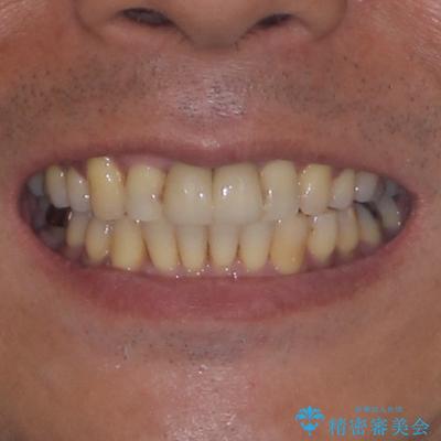 八重歯と突出感を改善 ワイヤー装置での矯正治療の治療後(顔貌)