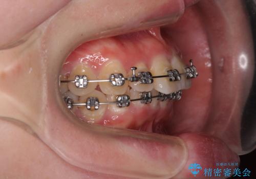 インビザラインが続けられない　ワイヤー矯正に切り替えてデコボコを改善の治療中