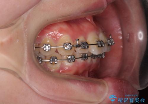 インビザラインが続けられない ワイヤー矯正に切り替えてデコボコを改善の治療中