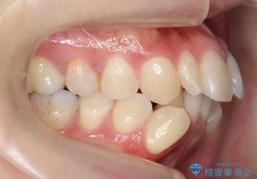 重度のがたつき 矯正治療+セラミック治療で綺麗な歯並びに 矯正専門では難しい治療の治療前