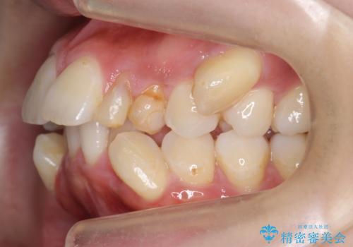 重度のがたつき 矯正治療+セラミック治療で綺麗な歯並びに 矯正専門では難しい治療の治療前