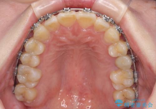 インビザラインが続けられない　ワイヤー矯正に切り替えてデコボコを改善の治療中