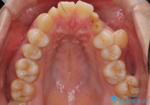 重度のがたつき 矯正治療+セラミック治療で綺麗な歯並びに 矯正専門では難しい治療の治療前