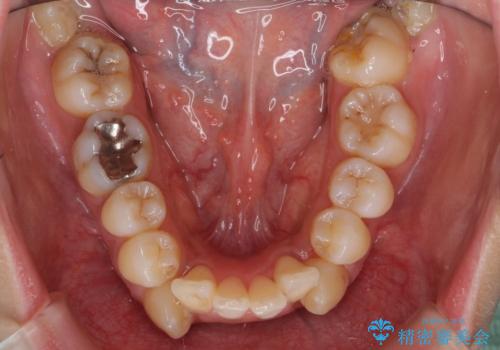 重度のがたつき 矯正治療+セラミック治療で綺麗な歯並びに 矯正専門では難しい治療の治療前