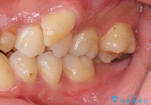 重度のがたつき 矯正治療+セラミック治療で綺麗な歯並びに 矯正専門では難しい治療の治療前