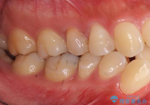 重度のがたつき 矯正治療+セラミック治療で綺麗な歯並びに 矯正専門では難しい治療の治療前