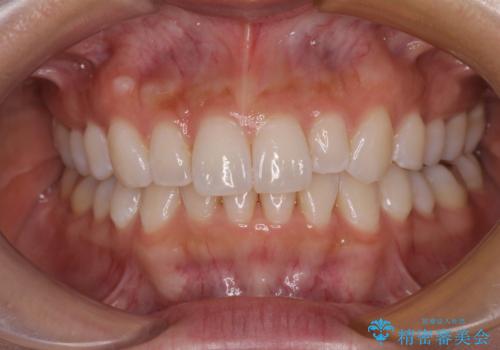 【モニター】前歯のデコボコと小さい前歯 インビザライン矯正とオールセラミッククラウン補綴治療の治療中