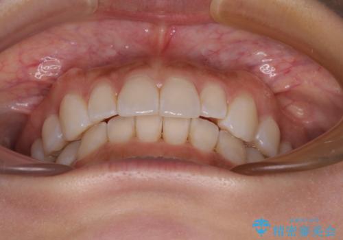 【モニター】前歯のデコボコと小さい前歯 インビザライン矯正とオールセラミッククラウン補綴治療の治療中