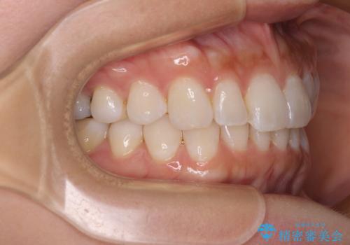 【モニター】前歯のデコボコと小さい前歯 インビザライン矯正とオールセラミッククラウン補綴治療の治療中