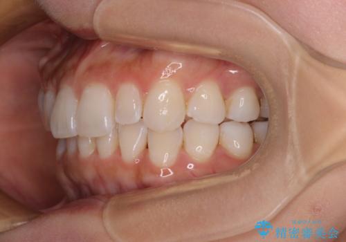 【モニター】前歯のデコボコと小さい前歯 インビザライン矯正とオールセラミッククラウン補綴治療の治療中