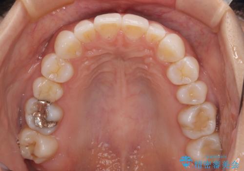 【モニター】前歯のデコボコと小さい前歯　インビザライン矯正とオールセラミッククラウン補綴治療の治療中