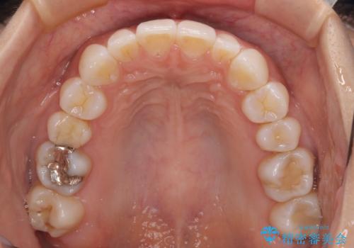 【モニター】前歯のデコボコと小さい前歯 インビザライン矯正とオールセラミッククラウン補綴治療の治療中