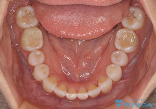 【モニター】前歯のデコボコと小さい前歯 インビザライン矯正とオールセラミッククラウン補綴治療の治療中