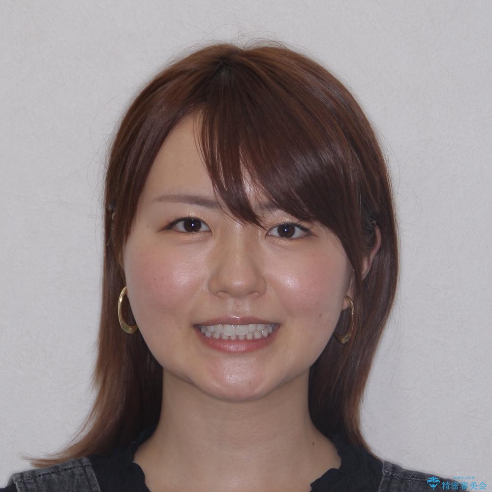 【モニター】前歯のデコボコと小さい前歯 インビザライン矯正とオールセラミッククラウン補綴治療の治療後(顔貌)