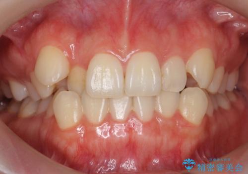 八重歯　歯を抜かずにマウスピース矯正で　インプラント矯正で上の奥歯を後ろに移動の治療前