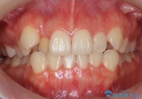 八重歯 歯を抜かずにマウスピース矯正で インプラント矯正で上の奥歯を後ろに移動