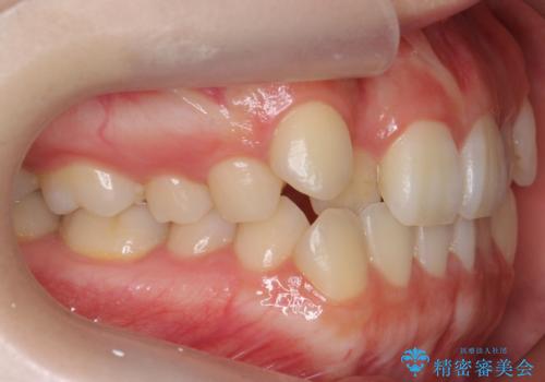 八重歯 歯を抜かずにマウスピース矯正で インプラント矯正で上の奥歯を後ろに移動の治療前