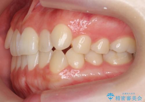 八重歯 歯を抜かずにマウスピース矯正で インプラント矯正で上の奥歯を後ろに移動の治療前
