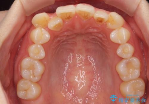 八重歯　歯を抜かずにマウスピース矯正で　インプラント矯正で上の奥歯を後ろに移動の治療前